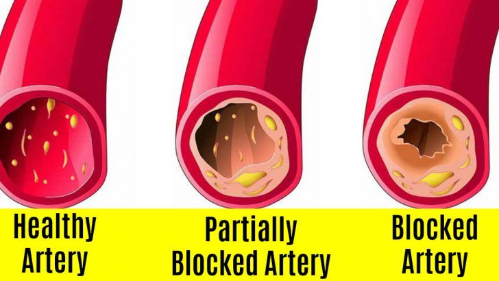 Here Are 7 Warning Signs You Have Blocked Arteries