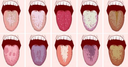 WHAT YOUR TONGUE IS TRYING TO TELL YOU ABOUT YOUR HEALTH