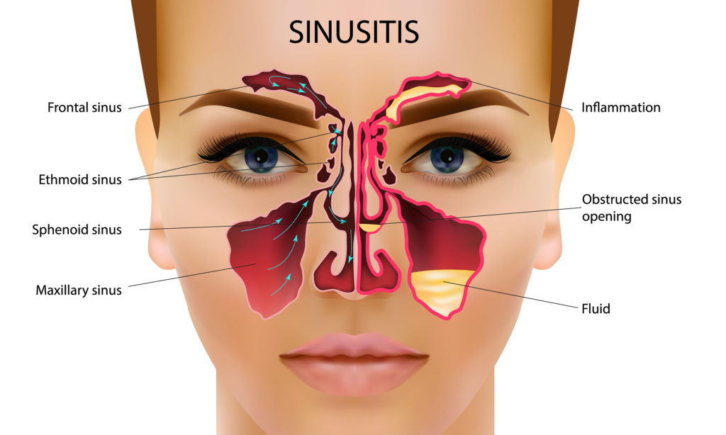 How To Treat Sinus Infections With Essential Oils