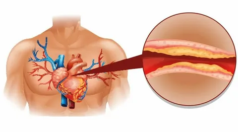 6 Effective Exercises for High Cholesterol