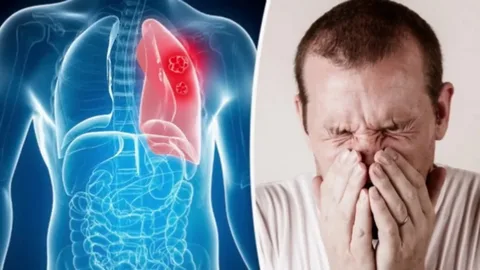 7 Signs of Lung Cancer You Might Be Ignoring