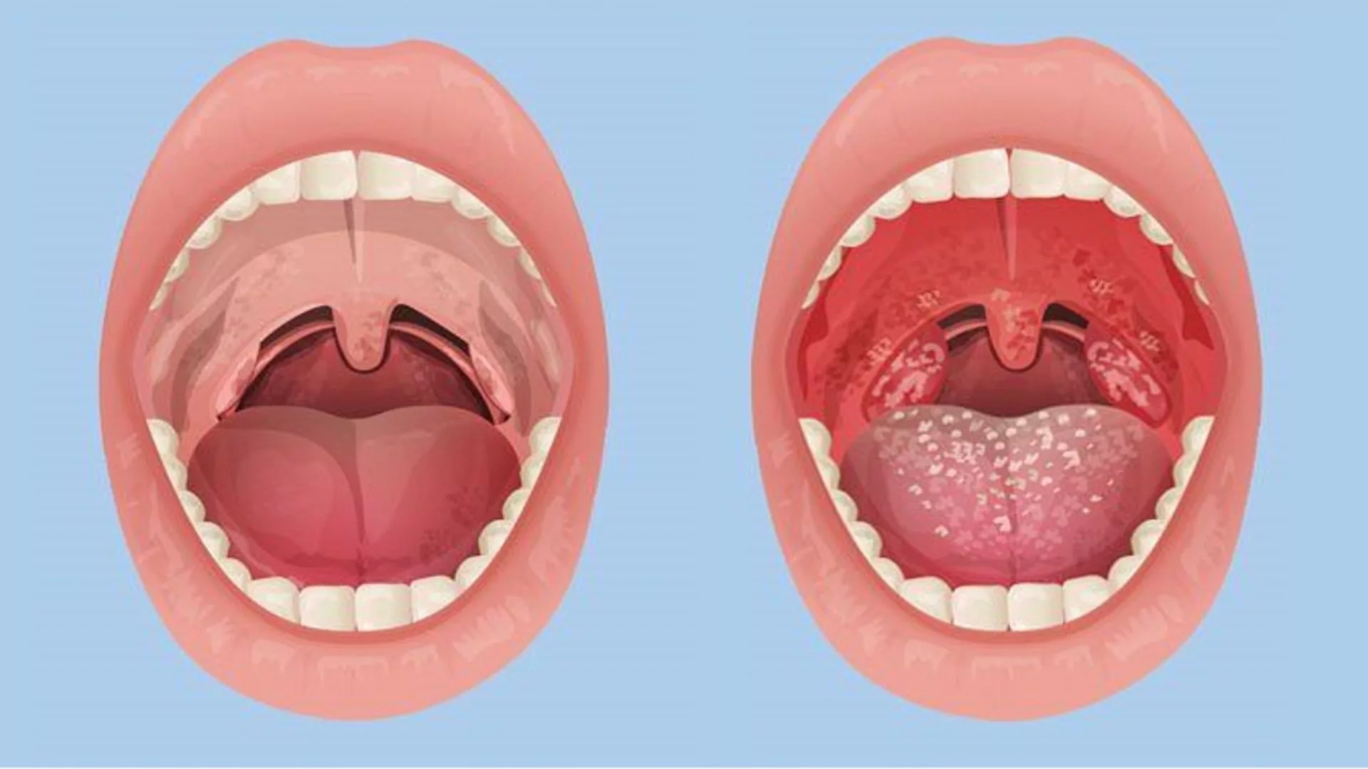 Remove Tonsil Stones Without Any Surgery!