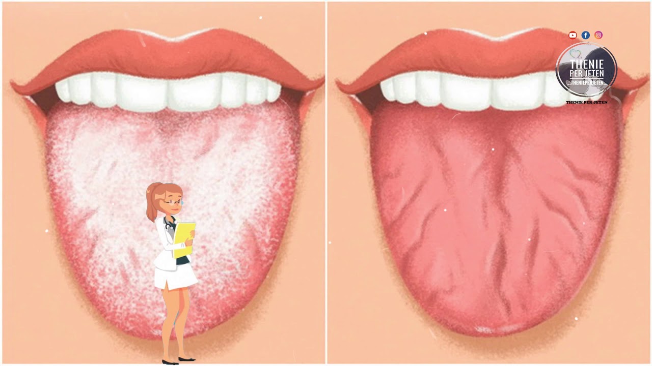 10 Ways to Get Rid of White Tongue and Make It Healthier