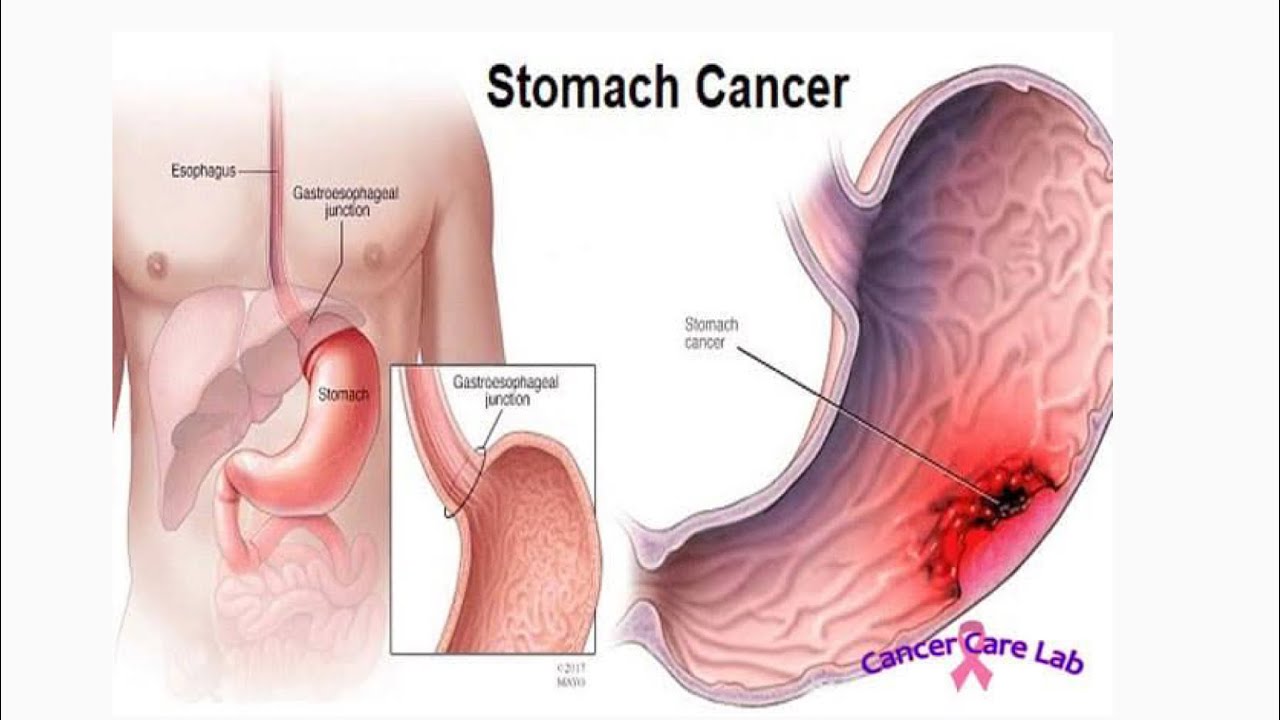 Stomach Cancer: A Deadly Disease That Is Often Overlooked