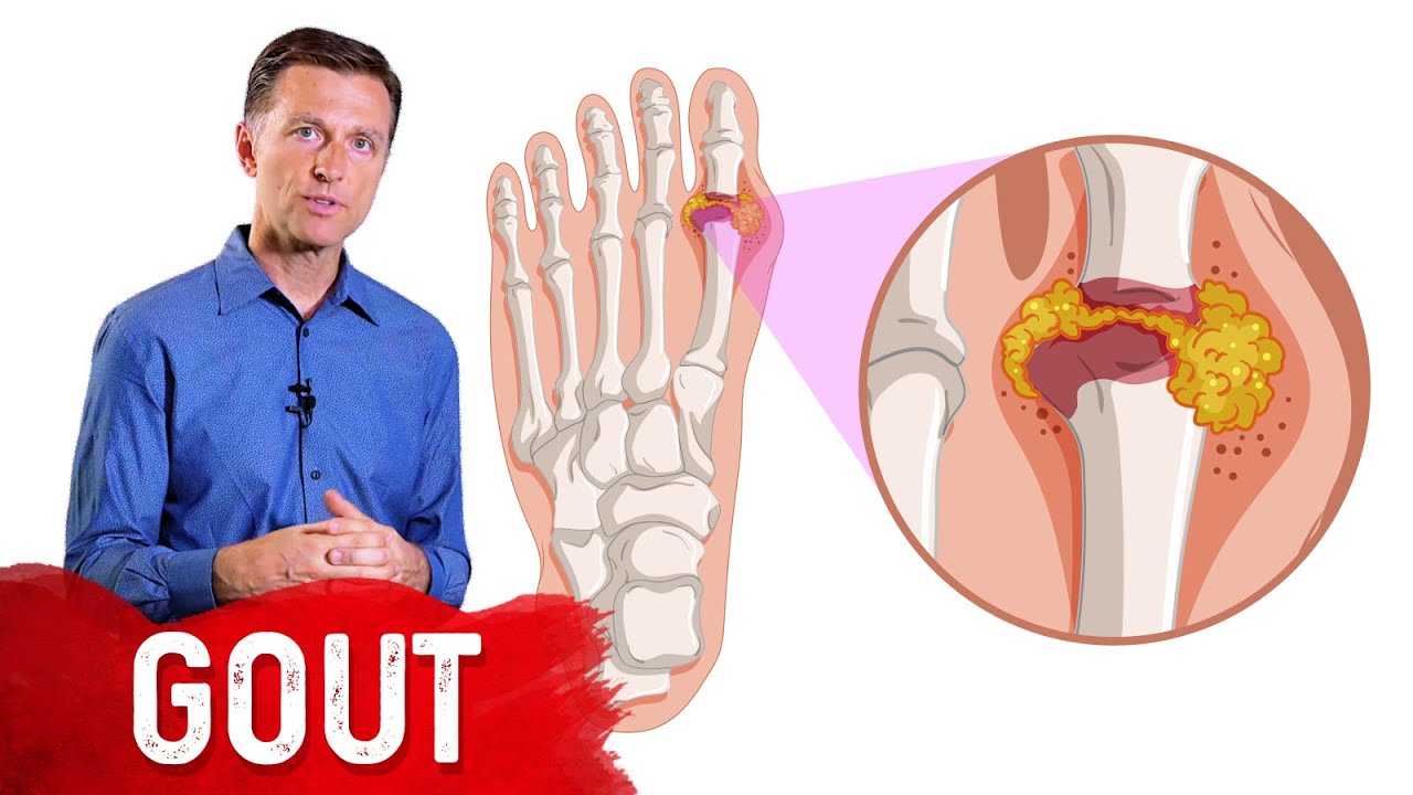 How to stop gout attack